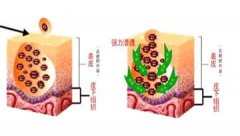 扁平疣的严重危害