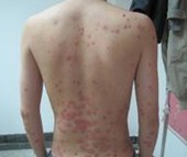 患有牛皮癣不宜吃螃蟹