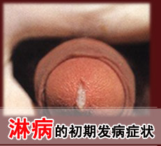 淋病