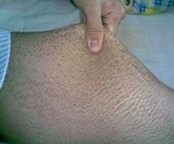 鱼鳞病的一些常识