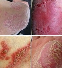 不同类型的牛皮癣分别有哪些症状表现