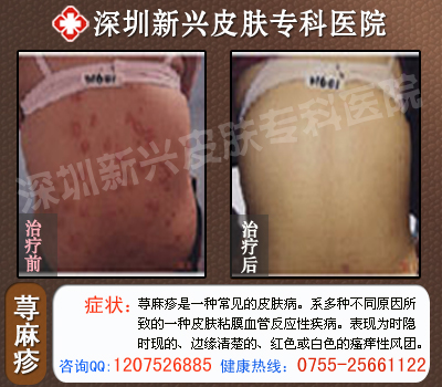 深圳荨麻疹专科医院