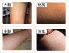 皮肤干燥易引发瘙痒症