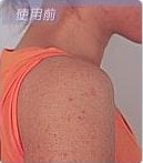 毛周角化