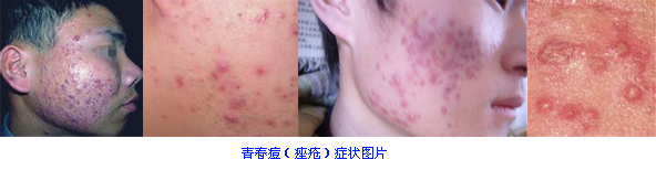 痤疮的症状图片