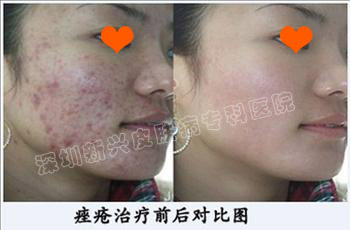 痤疮治疗前后对比图