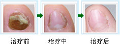 灰指甲易脆.jpg